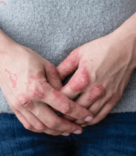Examples Of Eczema Res