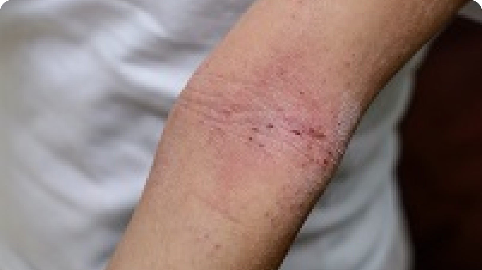 Examples of eczema